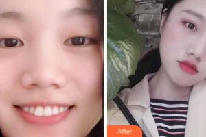 臺(tái)州國際眼科醫(yī)院李瑾整形價(jià)格表附切開雙眼皮案例展示