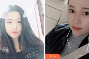 臺(tái)州國際眼科醫(yī)院林冰整形價(jià)格表附切開雙眼皮案例展示