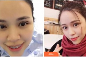 臺(tái)州國際眼科醫(yī)院余新平整形價(jià)格表附切開雙眼皮案例展示