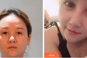 臺(tái)州國際眼科醫(yī)院張芳整形價(jià)格表附眼部綜合案例展示