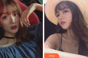 臺(tái)州國際眼科醫(yī)院于旭東整形價(jià)格表附切開雙眼皮案例展示