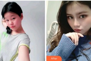 臺(tái)州國際眼科醫(yī)院葉良整形價(jià)格表附眼部綜合案例展示