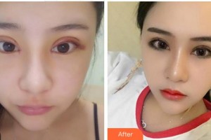 臺(tái)州國際眼科醫(yī)院余煥云整形價(jià)格表附切開雙眼皮案例展示