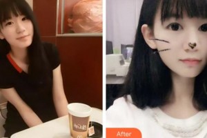 臺(tái)州國際眼科醫(yī)院曉整形價(jià)格表附切開雙眼皮案例展示