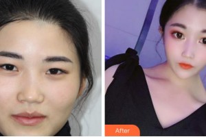 臺(tái)州國際眼科醫(yī)院徐肅仲整形價(jià)格表附眼部綜合案例展示