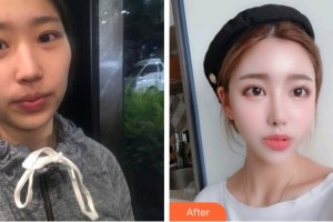 臺(tái)州國際眼科醫(yī)院許金玲整形價(jià)格表附切開雙眼皮案例展示