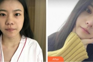 臺(tái)州國際眼科醫(yī)院汪育文整形價(jià)格表附切開雙眼皮案例展示