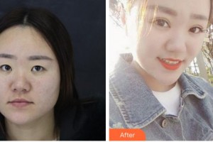 臺(tái)州國際眼科醫(yī)院許梅萍整形價(jià)格表附切開雙眼皮案例展示