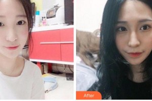 臺(tái)州國際眼科醫(yī)院陳惠整形價(jià)格表附埋線雙眼皮案例展示