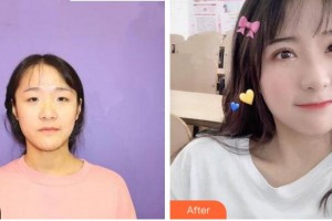 臺(tái)州妍度醫(yī)療美容門診部方奎整形價(jià)格表附眼部綜合案例展示