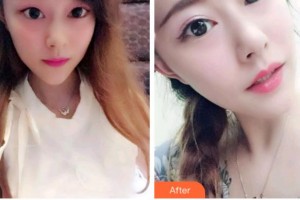 臺(tái)州康貝佳口腔醫(yī)院阿諾德.馬丁整形價(jià)格表附牙貼面案例展示