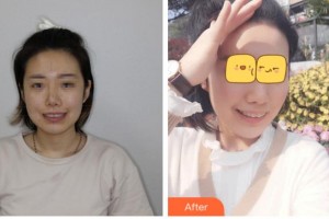 臺(tái)州拜博口腔醫(yī)院范沛沛整形價(jià)格表附牙齒隱形矯正案例展示