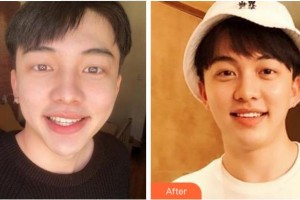 臺州康貝佳口腔醫(yī)院吳品芳整形價格表附美白貼片案例展示