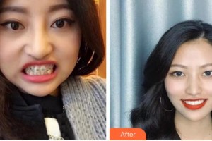 臺州康貝佳口腔醫(yī)院岳巍娜整形價格表附牙齒陶瓷矯正案例展示