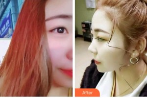 臺(tái)州康貝佳口腔醫(yī)院阮利芳整形價(jià)格表附超聲波潔牙案例展示