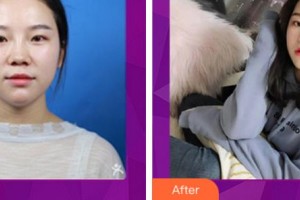 麗水慈愛醫(yī)院整形美容中心宋秀旭整形價格表附耳軟骨復(fù)合隆鼻案例展示