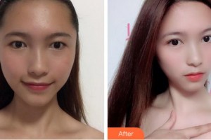 麗水慈愛醫(yī)院整形美容中心李柄旭整形價格表附眼部綜合案例展示