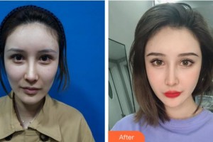 四川美萊醫(yī)學(xué)美容醫(yī)院夏秋整形價格表附埋線提升案例展示