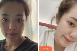 四川西嬋整形美容醫(yī)院楊秀珍整形價格表附光子嫩膚案例展示