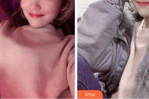 四川西嬋整形美容醫(yī)院孟家麟教授、整形價格表附超聲波潔牙案例展示