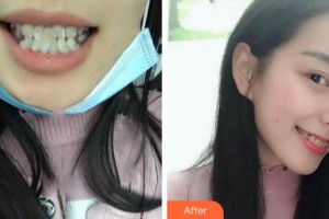 四川西嬋整形美容醫(yī)院石中慧美容口腔科醫(yī)師整形價格表附牙齒陶瓷矯正案例展示