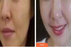 四川西嬋整形美容醫(yī)院楊曉惠整形價格表附埋線提升案例展示