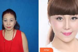 四川美萊醫(yī)學(xué)美容醫(yī)院蒙潔整形價格表附埋線提升案例展示