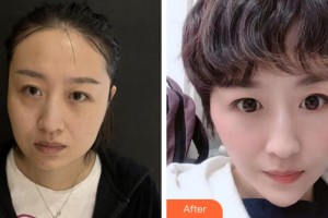 四川華人醫(yī)聯(lián)整形美容醫(yī)院黃偉整形價格表附埋線提升案例展示