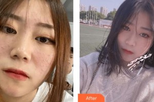 四川華人醫(yī)聯(lián)整形美容醫(yī)院廖萬斌整形價格表附光子嫩膚案例展示