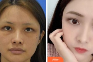 四川省人民醫(yī)院整形外科張家建整形價(jià)格表附埋線提升案例展示