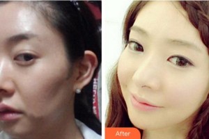 四川省人民醫(yī)院整形外科杜麗平整形價格表附埋線提升案例展示