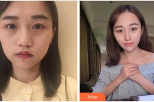 四川武警總隊(duì)醫(yī)院樂(lè)山分院燒傷整形科袁文周整形價(jià)格表附熱瑪吉案例展示