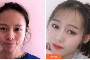 四川美萊醫(yī)學(xué)美容醫(yī)院韓國(guó)棟整形價(jià)格表附埋線提升案例展示