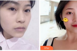 四川武警總隊(duì)醫(yī)院樂(lè)山分院燒傷整形科帥秀蓉整形價(jià)格表附埋線提升案例展示