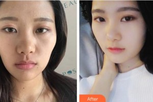 四川美萊醫(yī)學(xué)美容醫(yī)院宋奉宜整形價(jià)格表附熱瑪吉案例展示