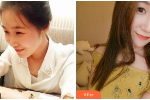 四川美萊醫(yī)學(xué)美容醫(yī)院李殷政整形價格表附熱瑪吉案例展示