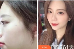 四川美萊醫(yī)學(xué)美容醫(yī)院吳幼文整形價格表附金屬托槽矯正案例展示