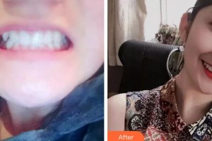 四川大學(xué)華西口腔醫(yī)院美容中心鄧次冰整形價格表附牙齒陶瓷矯正案例展示