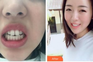 四川大學(xué)華西口腔醫(yī)院美容中心張招娣整形價格表附隱形托槽矯正案例展示