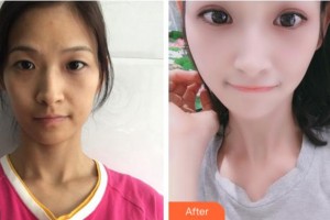 四川西嬋整形美容醫(yī)院劉輔蓉整形價格表附眼部綜合案例展示