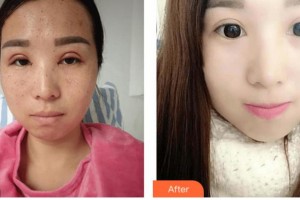 四川西嬋整形美容醫(yī)院楊海皎整形價格表附皮膚管理案例展示
