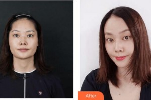 四川西嬋整形美容醫(yī)院林燕整形價格表附嫩膚祛斑案例展示