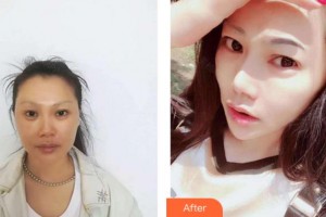 四川圣麗整形美容醫(yī)院肖開(kāi)宇整形價(jià)格表附光子嫩膚案例展示