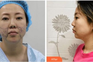 四川圣麗整形美容醫(yī)院王才惠整形價(jià)格表附埋線提升案例展示