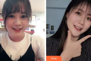 四川華人醫(yī)聯(lián)整形美容醫(yī)院成偉整形價格表附金屬托槽矯正案例展示