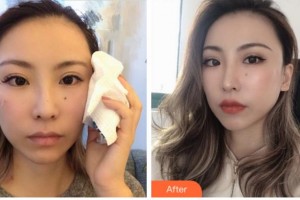 四川華人醫(yī)聯(lián)整形美容醫(yī)院黃偉整形價(jià)格表附埋線提升案例展示