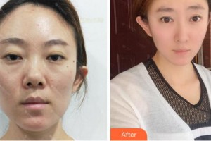 四川華人醫(yī)聯(lián)整形美容醫(yī)院劉全整形價格表附鼻部綜合案例展示