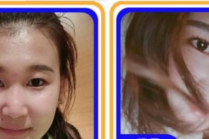 四川省紅十字腫瘤醫(yī)院整形科林強整形價格表附硅膠隆鼻案例展示