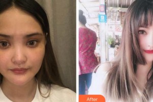 四川省紅十字腫瘤醫(yī)院整形科虞冬梅整形價格表附耳軟骨復(fù)合隆鼻案例展示