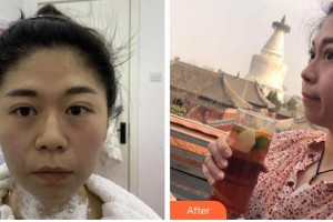 四川華美紫馨醫(yī)學(xué)美容醫(yī)院郁梅整形價(jià)格表附熱瑪吉案例展示